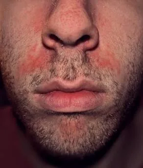 Skin barrier illustration