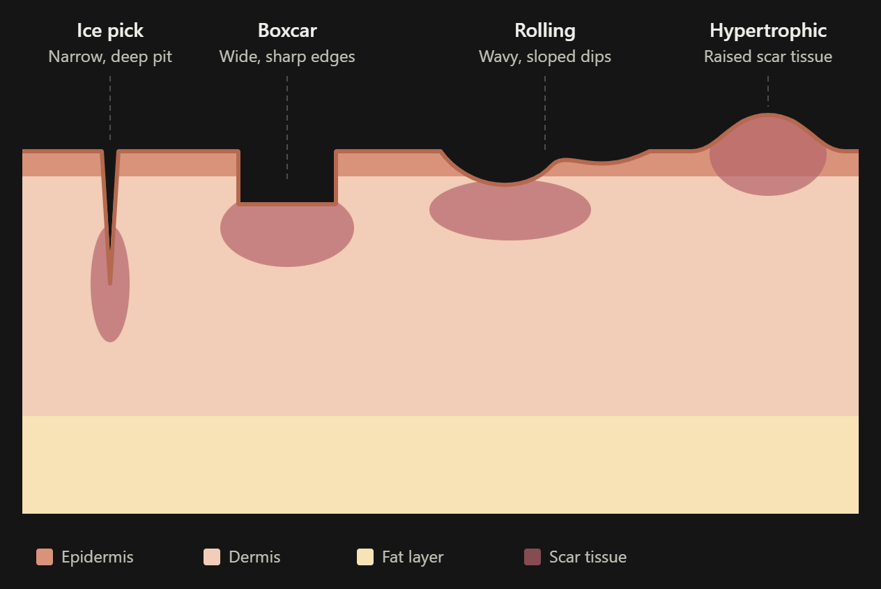 Skincare products used in a simple acne-care routine